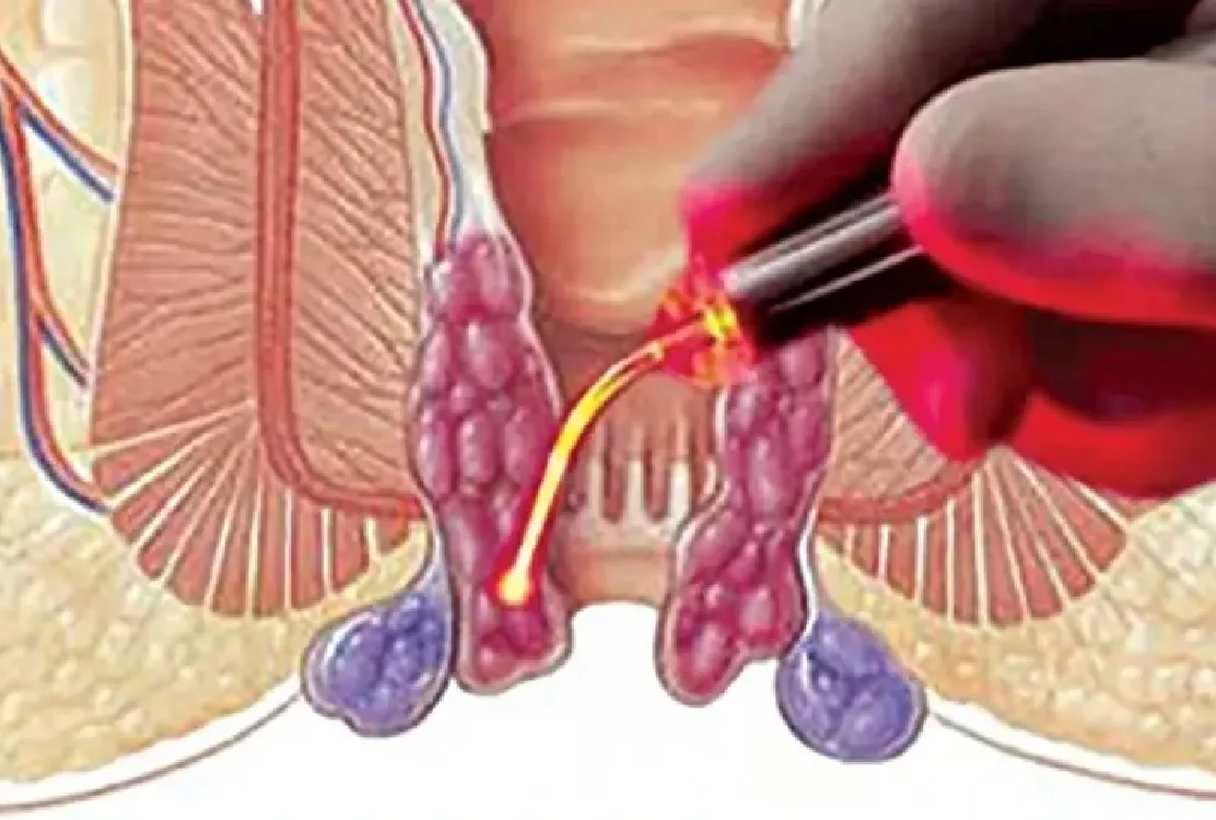 Safe procedures for piles treatment with laser in Tehran